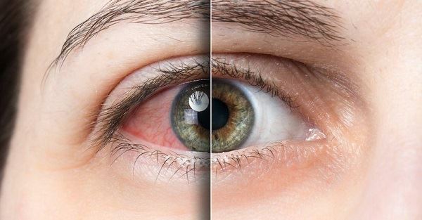 Lutein có thể giúp mắt khô không?
